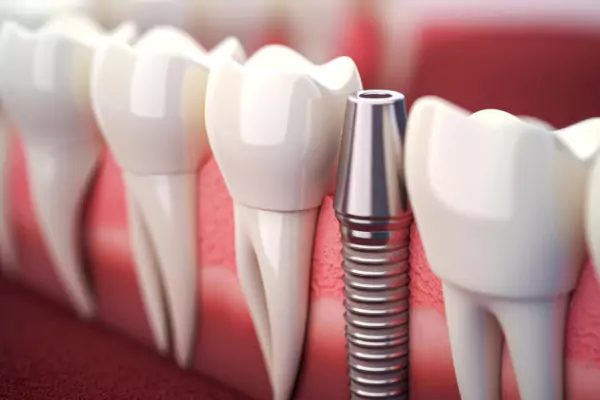 Root canal